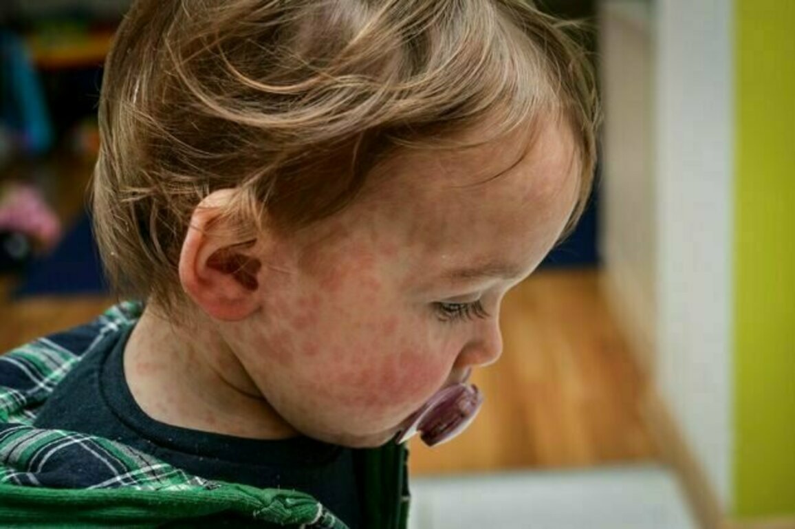 Measles cases are surging globally. Should children be vaccinated earlier?