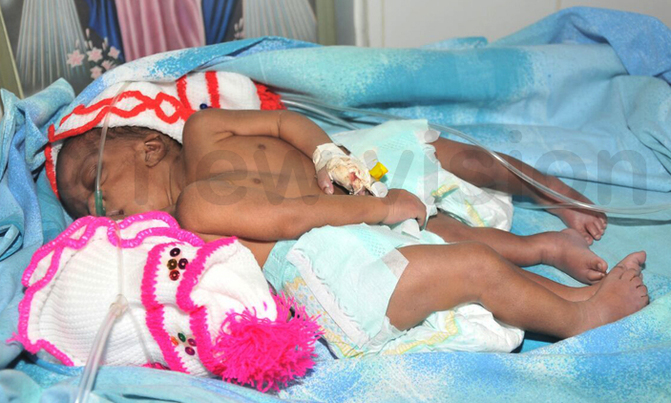 Wakiso woman gives birth to Siamese twins Wakiso woman gives birth to Siamese twins