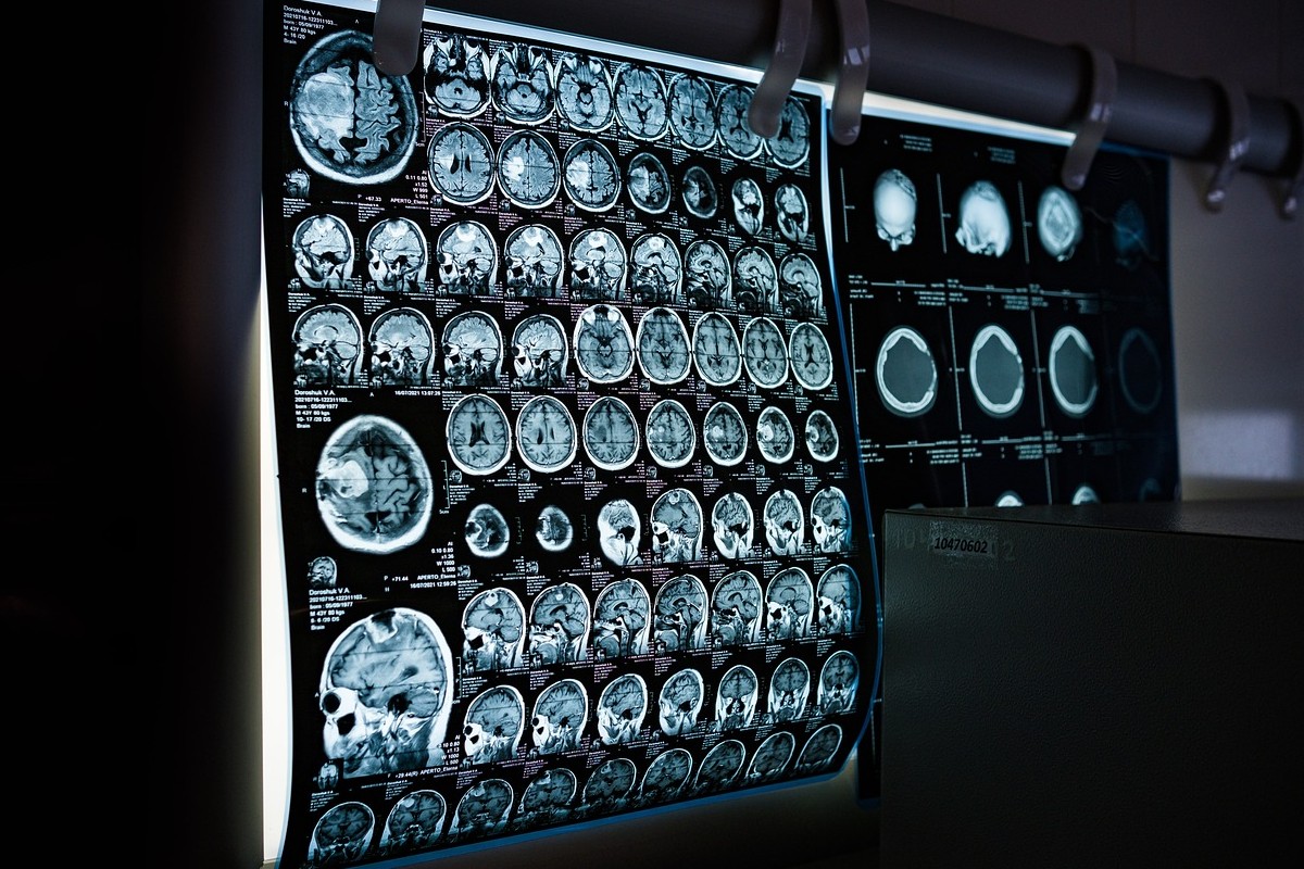 AI tool aims to spot early signs of dementia from scans