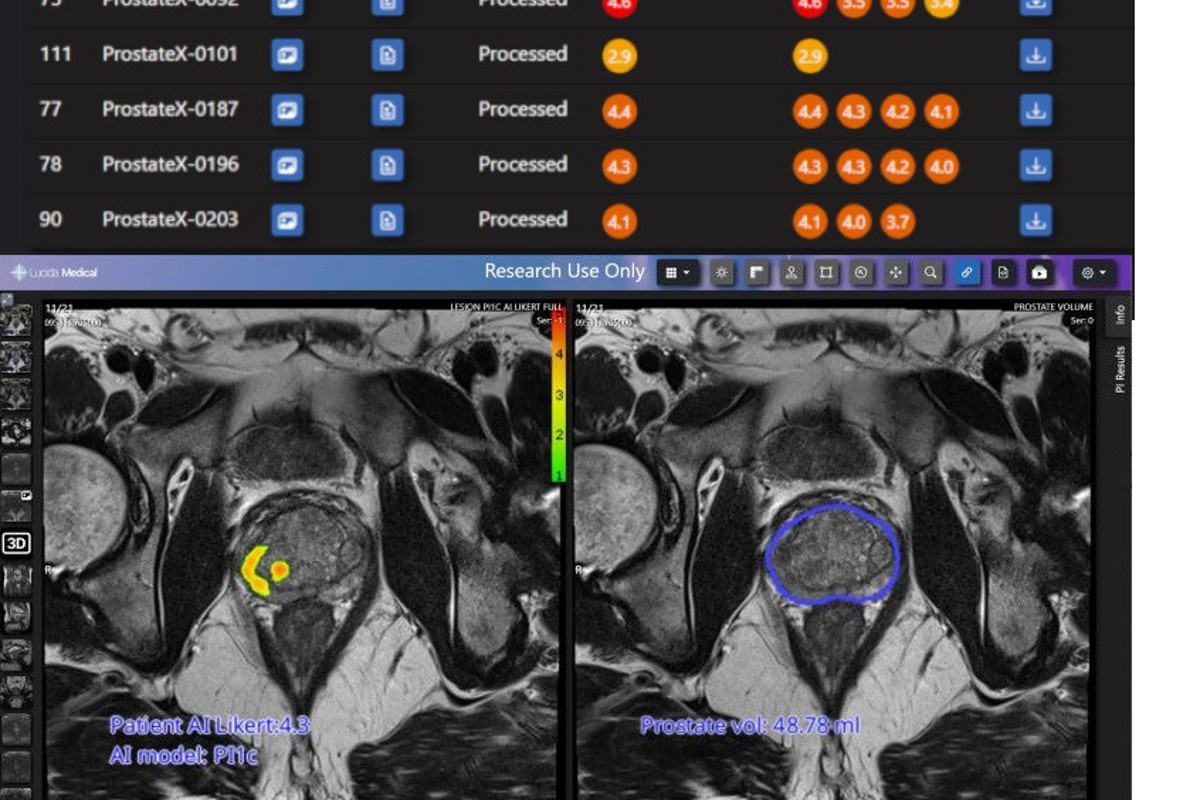 Leeds Teaching Hospitals NHS Trust pilots AI tool for prostate cancer diagnosis