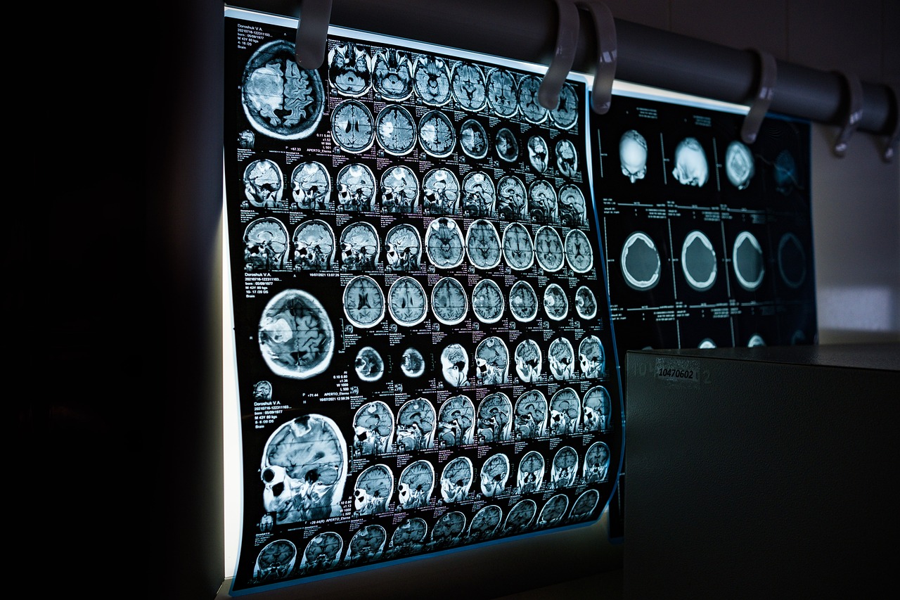 AI tool could enhance and personalise brain tumour imaging