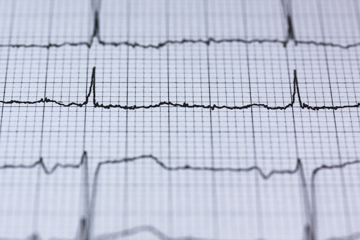 AI model can predict health risks from ECGs