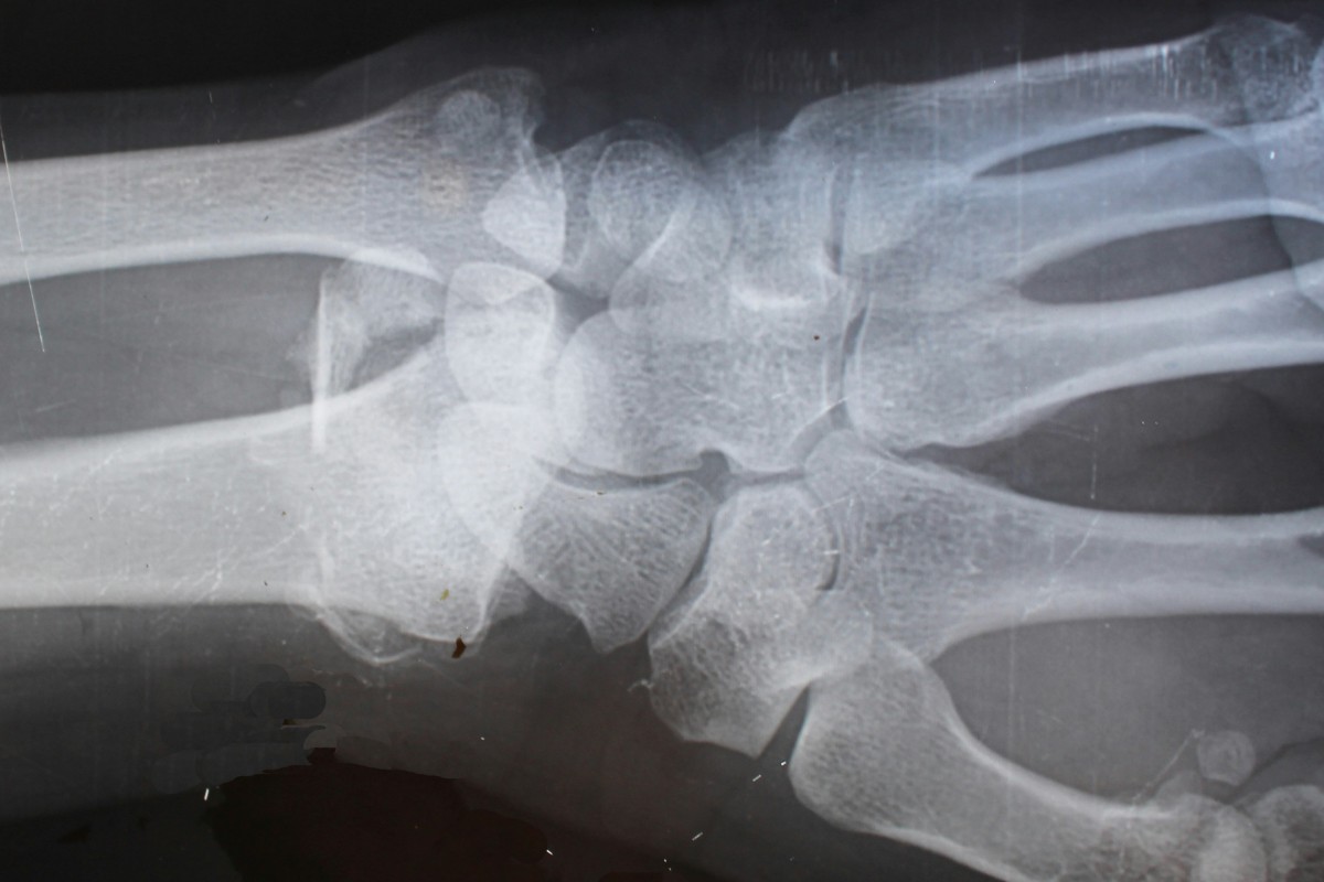 AI technology used to detect fractures