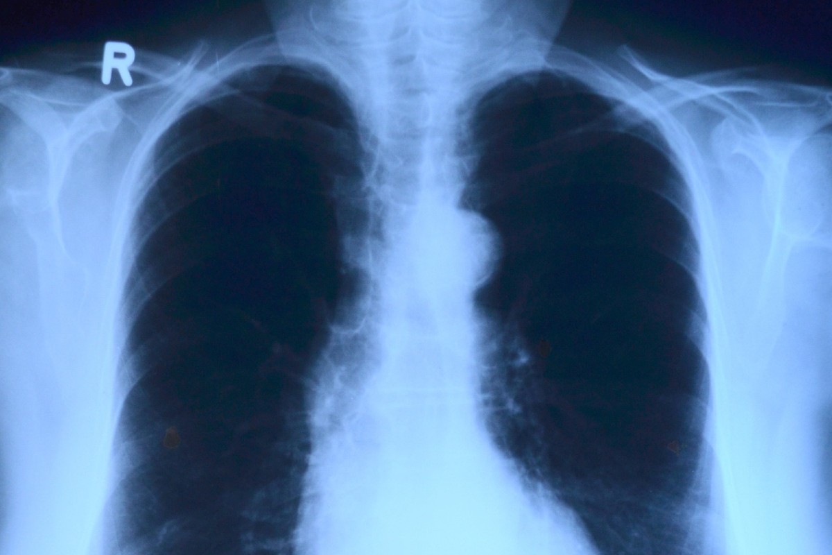 London initiative uses AI for faster chest X-ray results