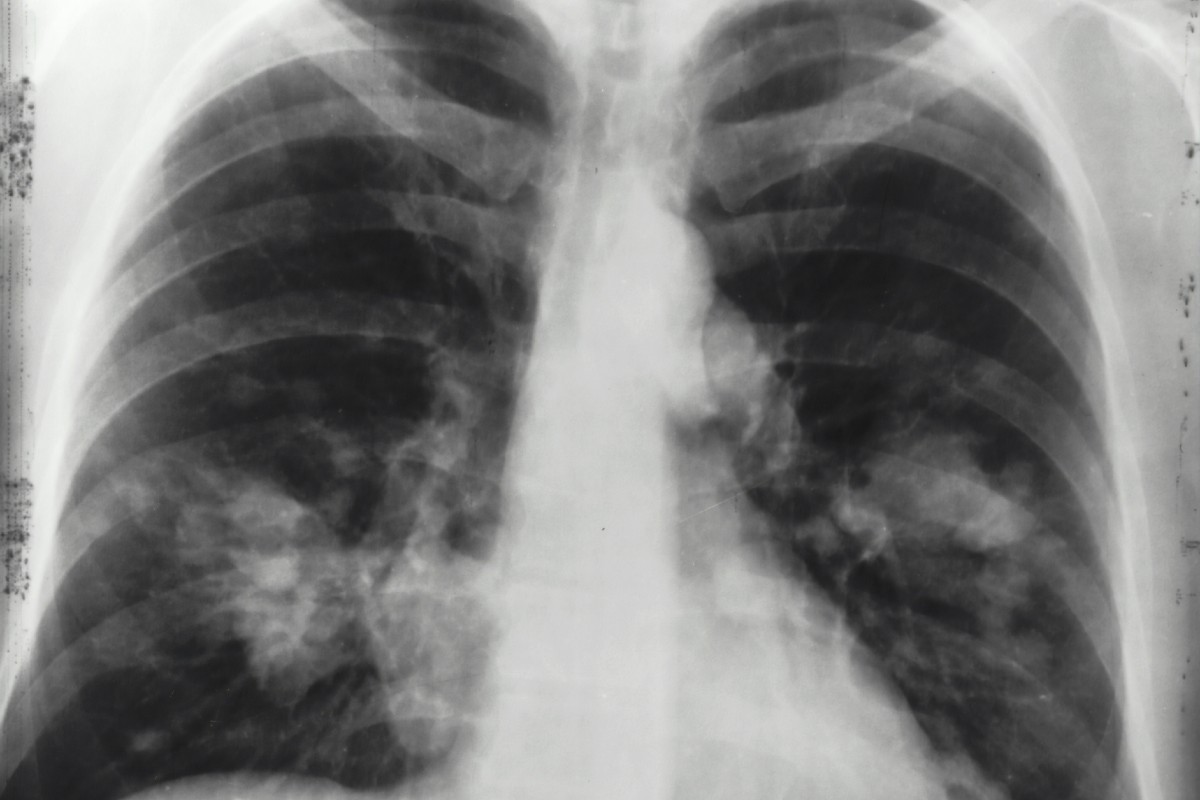 Lung cancer biomarker testing trial sees drop in deaths