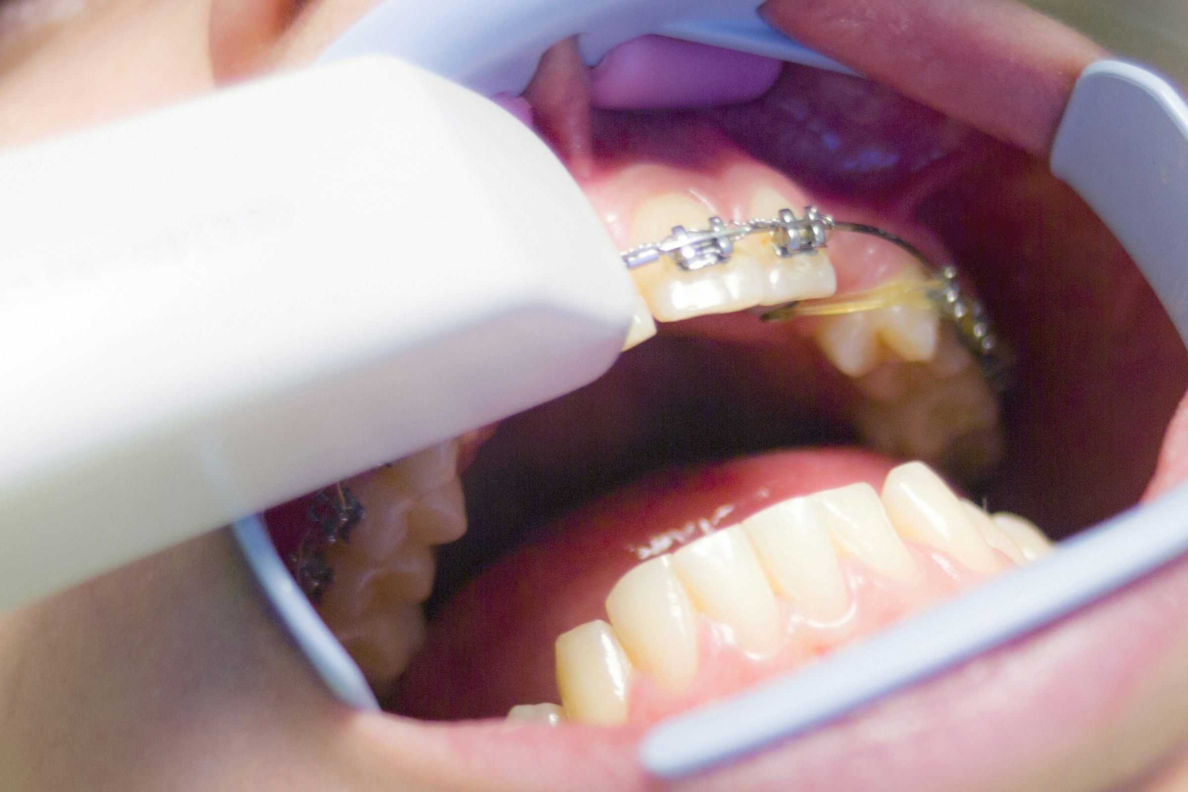 Only two in five adults accessing NHS dental care