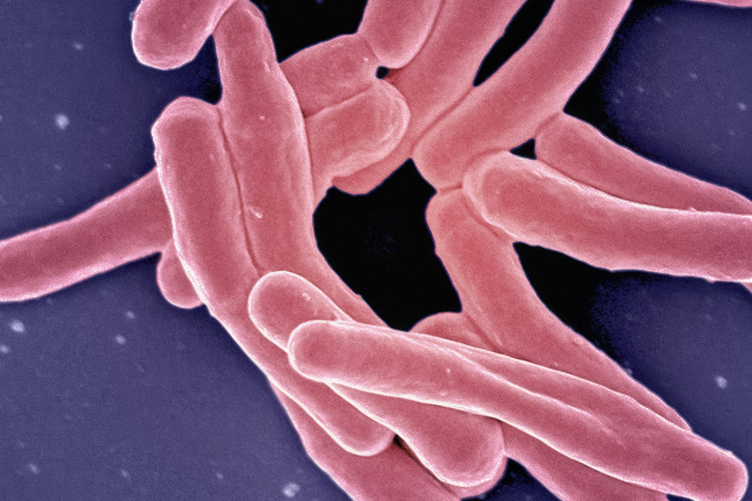 Tuberculosis levels rise 11% in England in 2023