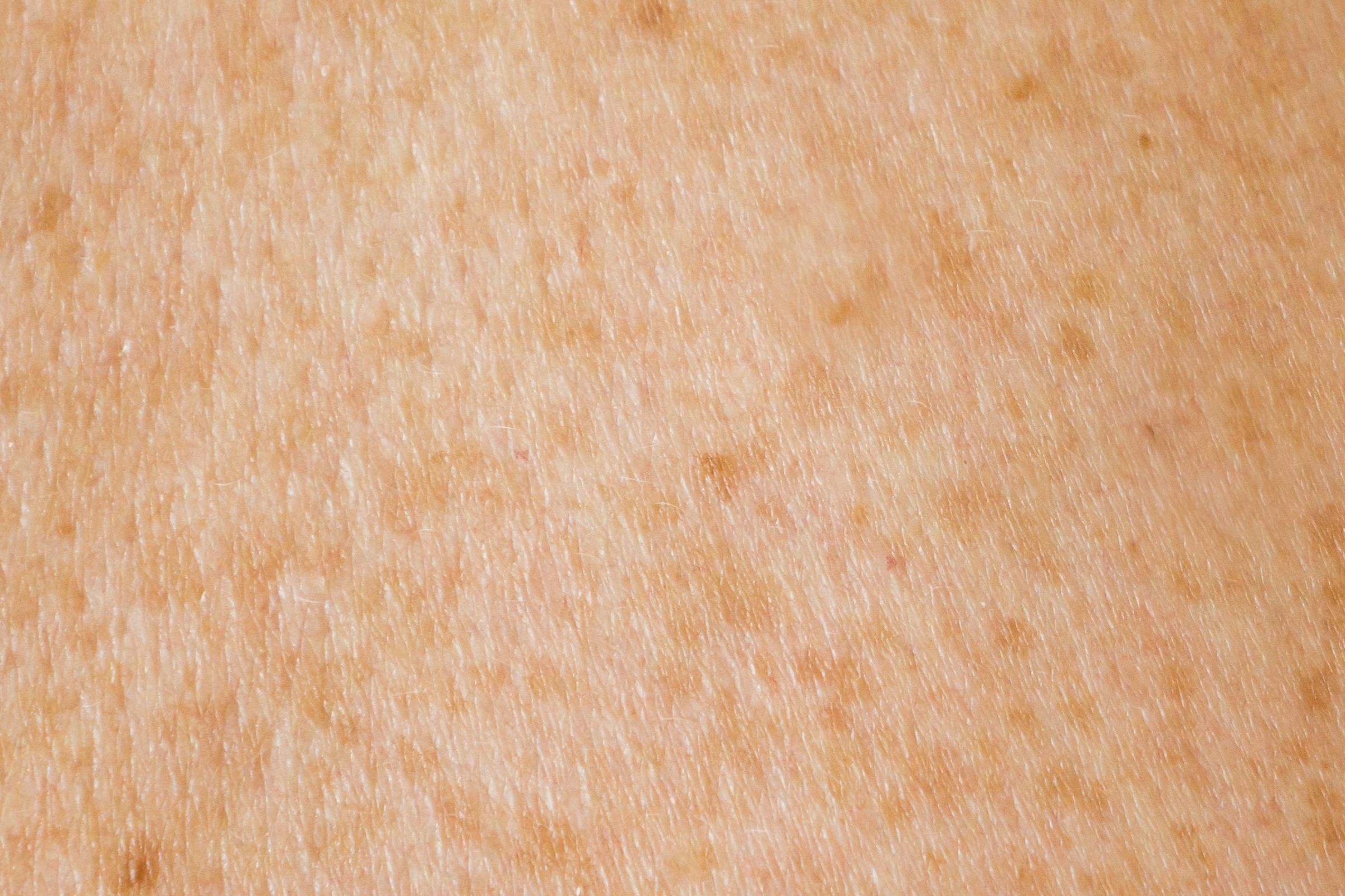 MPs launch inquiry into UV safety