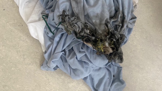 Warning issued after patient sets herself on fire while vaping
