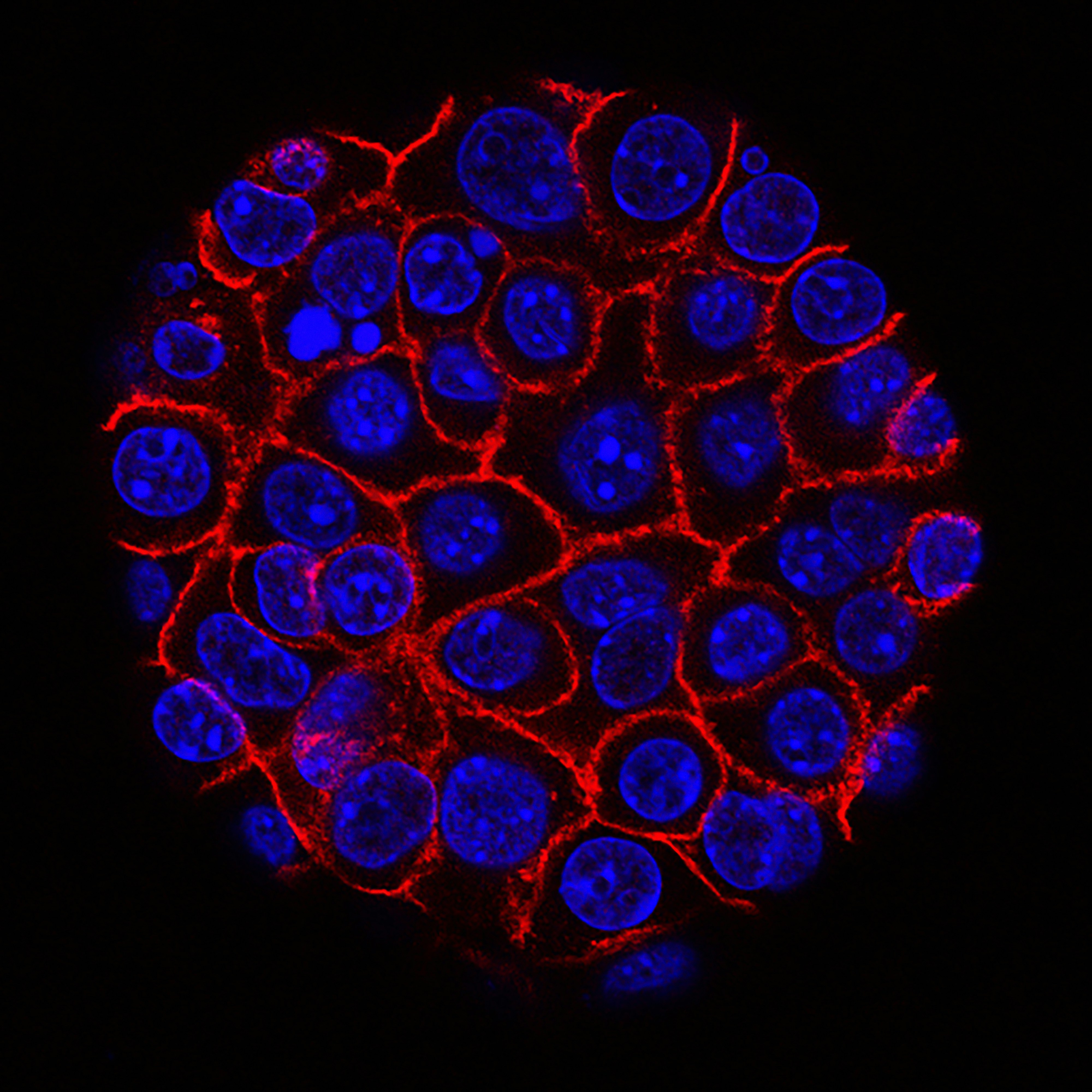 Men with early prostate cancer to be offered precision radiotherapy
